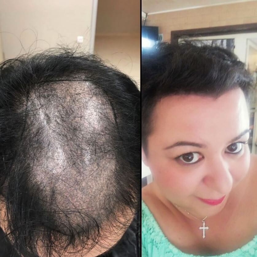 ROOT REVIVE™: Detén la caída y recupera tu densidad capilar con el poder del romero