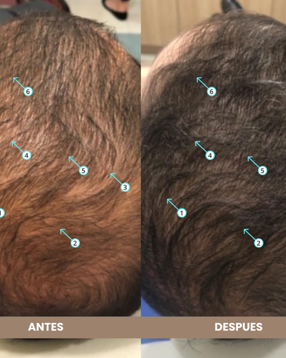 SPRAY SPECTRAL - NANOXIDIL 5% CRECIMIENTO DE BARBA Y CABELLO