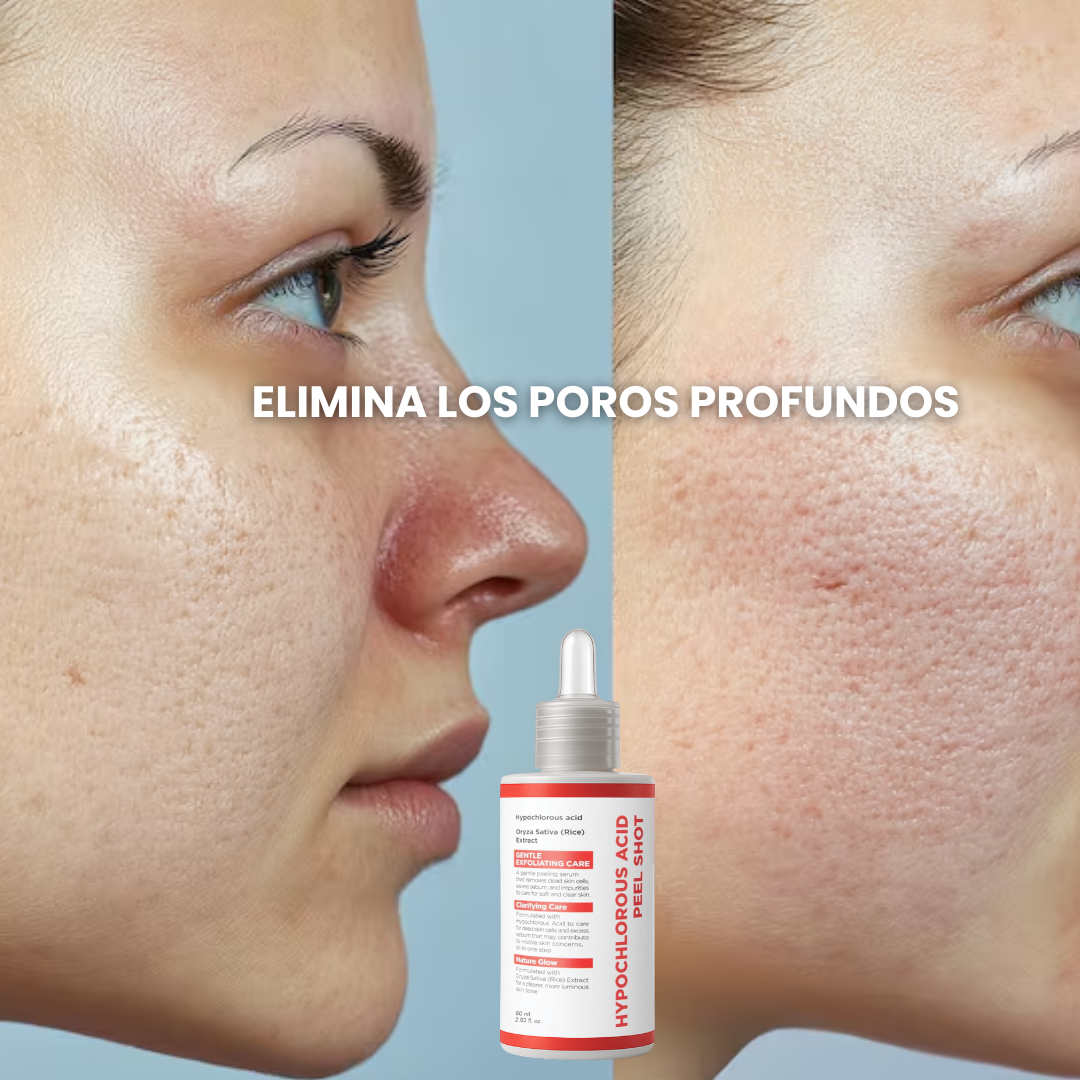 Hypochlorous Acid Peel - Tratamiento para la piel muerta de la cara y poros abiertos