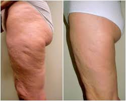 Golden Sweat: Borra estrías visibles y revierte la celulitis profunda en solo 18 días