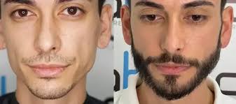 VikingGrowth: Despierta los folículos inactivos de tu barba y recupera tu masculinidad