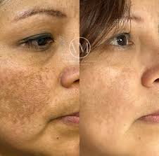 Crema Kojic Radiance 21 – Elimina Manchas Oscuras de la cara