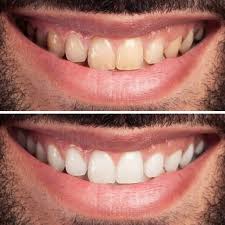 CocoWhite Pro™ con Aceite de Coco – Elimina bacterias, mal aliento y dientes amarillos