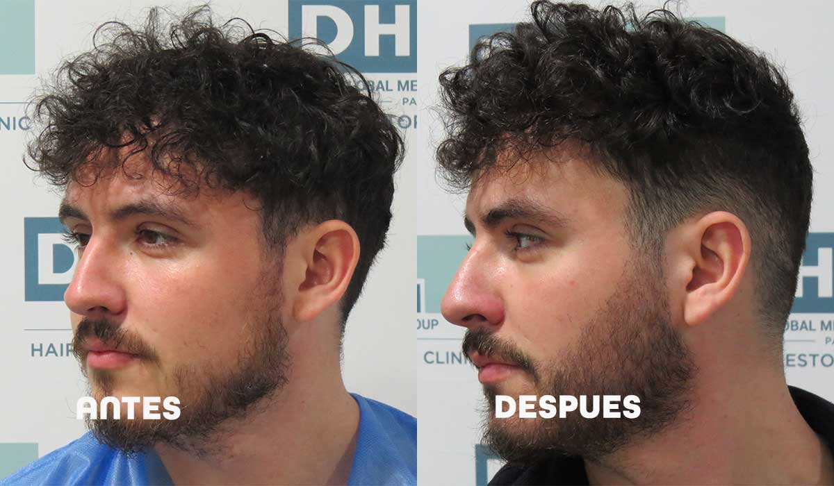 ROOT RENEWAL | Activa el crecimiento de la barba y rellena huecos con el romero